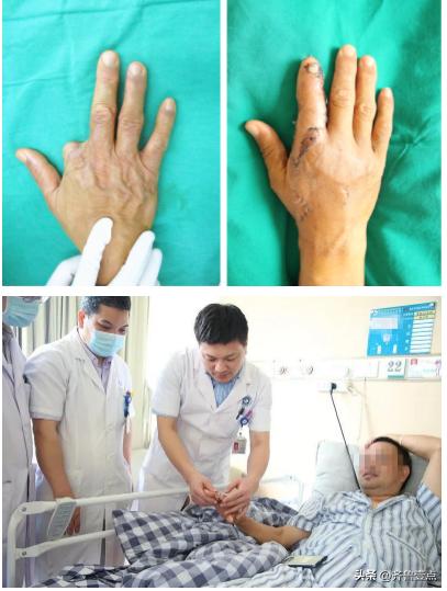 手指缺失10級傷殘圖九級傷殘一共賠幾萬插圖